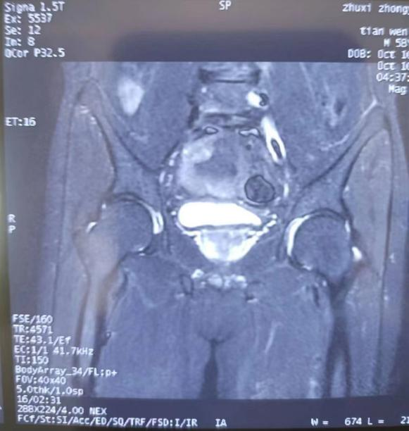 射频消融术治疗腰椎间盘突出 “一针”见效！