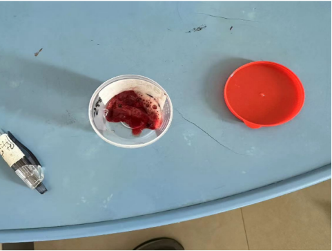 竹溪县中医医院开展支气管动脉介入栓塞手术