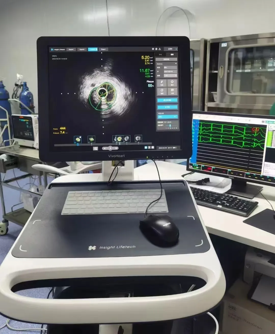 医疗新突破！竹溪县中医医院开展全县首例冠脉血管内超声（IVUS）指导下支架植入术